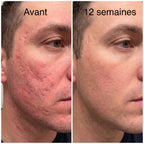 Soreva™ Stick pour le remodelage des cicatrices